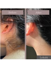 ロカヒ(Lokahi)/うなじ脱毛ビフォーアフター