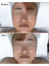 ソワナ(soina)/【神楽坂駅/フェイシャル/毛穴】