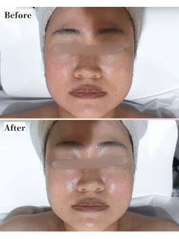 ソワナ(soina)/【神楽坂駅/フェイシャル/毛穴】