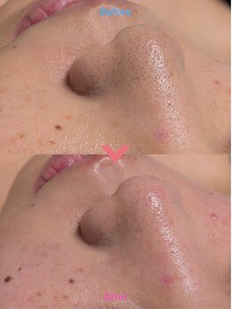 ルミナリー 仙台五橋(luminary)/ハイドロフェイシャル