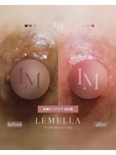 エルビービュティーサロン(LB BEAUTY SALON)/【ルメラ乳輪】実績数関西1★