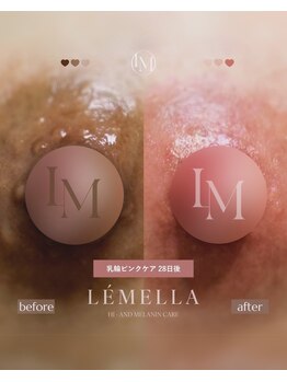 エルビービュティーサロン(LB BEAUTY SALON)/【ルメラ乳輪】実績数関西1★