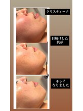 サロンドエムジョリー 横浜(Salon de M jolie)/日焼けした肌をリセット！