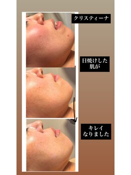 サロンドエムジョリー 横浜(Salon de M jolie)/日焼けした肌をリセット!