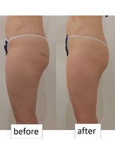 クレール アオヤマ(CLAIRE AOYAMA)/太ももつけ根リンパスッキリ