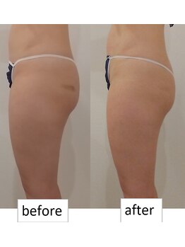 クレール アオヤマ(CLAIRE AOYAMA)/太ももつけ根リンパスッキリ