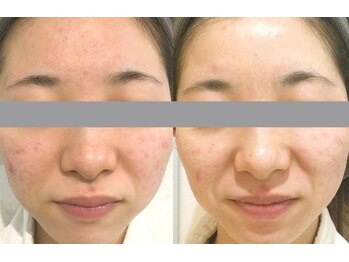 ヴィータローズディセ 名古屋本店(VITA ROSE Desse)/オーダーメイドフェイシャル