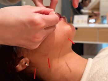 パレット(PALETTE)/【施術風景】鍼灸/マッサージ