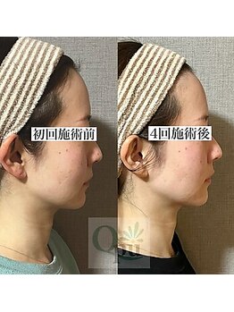 キュープ 鹿児島伊集院店(Qpu)/横顔もこんなに変わります！