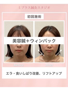 ミプラス鍼灸スタジオ/ビフォーアフター