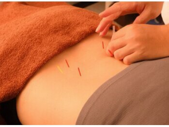 藤本整骨院 鍼灸院 長崎岩屋町本院/鍼灸施術