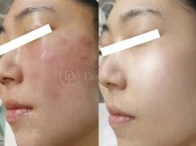 スピカ(SPICA)/ダクトピール