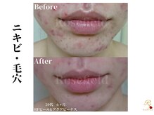 ローズフィールド(Rosefield)/RFピール/ニキビ/シミ/毛穴