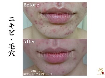 ローズフィールド(Rosefield)/RFピール/ニキビ/シミ/毛穴