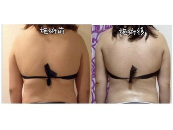 クレマチス 池袋店(Clematis)/施術7回での痩身変化です。