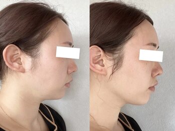 メイクアップス(makeups)/リフトアップフェイシャル