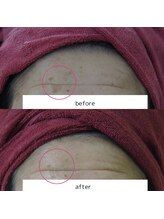 アップルミント/＜フェイシャル＞before・after