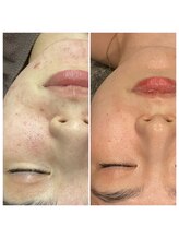 いわさき鍼灸整骨院/ハーブピーリング