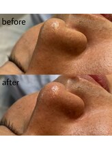 ヴィシアス(VIXIAS)/肌管理/毛穴洗浄