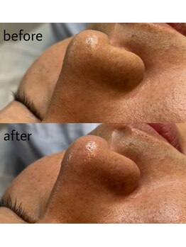 ヴィシアス(VIXIAS)/肌管理/毛穴洗浄