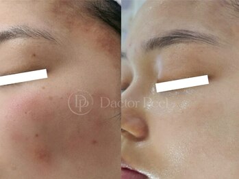 スピカ(SPICA)/ダクトピール