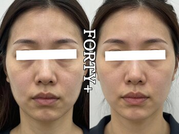 フォーティープラス(FORTY+)/施術事例