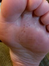 フットケアサロン ラビフット(Rabbi foot)/無数の魚の目