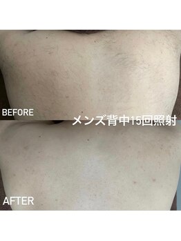 ココ(Coco)/背中脱毛