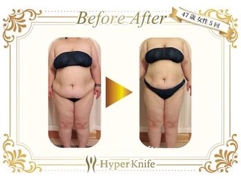 カワイ ビューティーサロン 新宿西口店(Kawai Beauty Salon)/【ハイパーナイフ】before/after