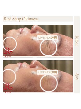 ルヴィショップ 沖縄(REVI SHOP)/REVI陶肌トリートメント