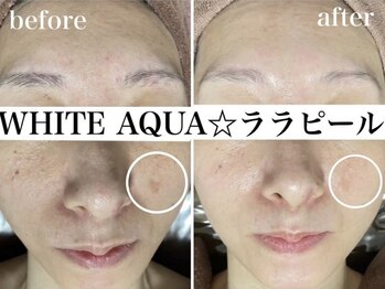 ホワイトアクア 京橋店(WHITE AQUA)/ララピール/ニキビケア