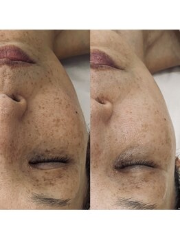 サロン ド ボーテ シャルル(Chaleureux)/大人の肌悩み.蓄積したシミ