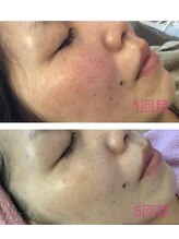 ラフレ(Rafre)/シリカピーリング