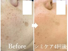 ニコ アンド キャンディー(Nico.&Candy)/本気でシミ改善したい方募集中