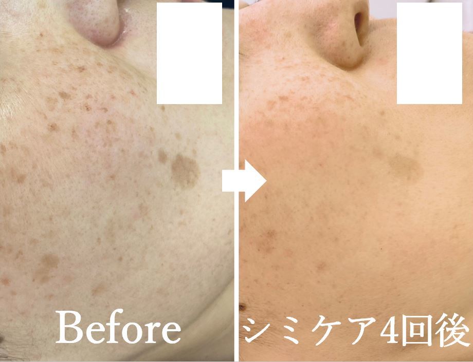 ニコ アンド キャンディー(Nico.&Candy)/本気でシミ改善したい方募集中