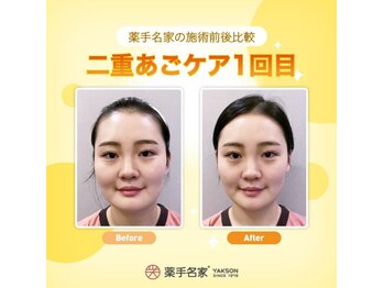 薬手名家 南青山店/二重あごケア1回前後