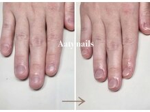 アーティネイルズ(Aaty Nails)/メンズの深爪矯正モニターも募集