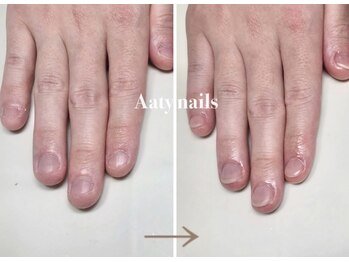 メンズの深爪矯正モニターも募集