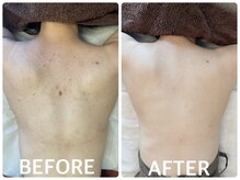 ハーブピーリング 恵比寿/背中ニキビ/くすみ/毛穴引締