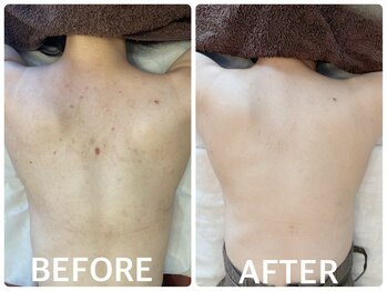 ハーブピーリング 恵比寿/背中ニキビ/くすみ/毛穴引締