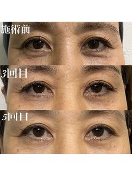 コリー(Kolly)/目元が別人級！？