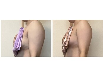 ローズ 下松(ROSE)/【二の腕＋バストUP】根強い人気