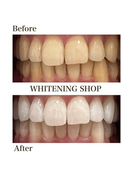 ホワイトニングショップ 泉佐野店/フリーパスコースbefore after