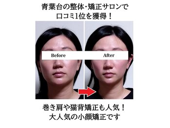 みなと/エラ周り・頬骨の出っ張りにも◎