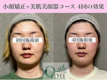 キュープ 表参道店(Qpu)/小顔矯正4回コースの変化