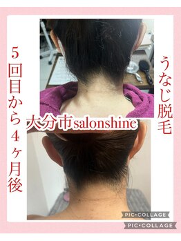 サロンシャイン(Salon Shine)/しっかり変わる!うなじ脱毛