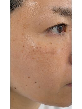 スキンラボプラス(SKIN LABO +)の写真/県内希少なIPLア導入店!くすみやシミケアで透明感のある陶器肌へ♪
