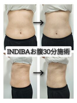 ビー アンド エイチ(B&H)/お腹インディバ30分