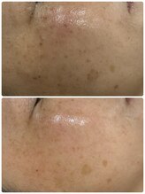 ギャラクシービューティー(galaxy beauty)/プラズマしみケア