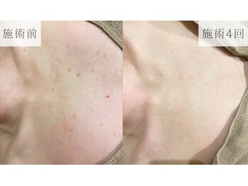 リーフィア(Leafia)/【肌見せの季節に!】